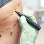 Liposuctie – Ce schimba cu adevarat o astfel de operatie?