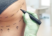 Liposuctie – Ce schimba cu adevarat o astfel de operatie?