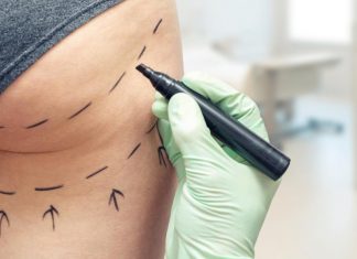 Liposuctie – Ce schimba cu adevarat o astfel de operatie?