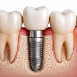 Implant dentar: prețul nu mai este un impediment, ci o decizie informată în 2026