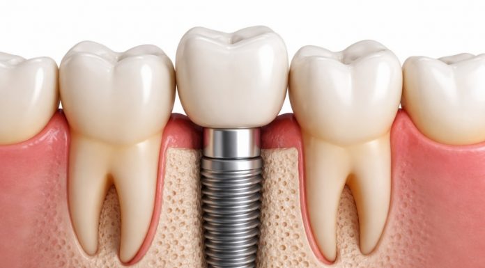 Implant dentar: prețul nu mai este un impediment, ci o decizie informată în 2026